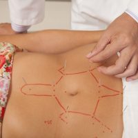 Overindulged yesterday? The holidays often leave us feeling a little heavier than normal. Did you know acupuncture can be used to aid in weight loss?