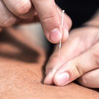 Many practitioners say that acupuncture can help relieve the symptoms...