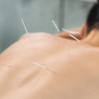 Do you have PCOS related infertility? Acupuncture may help.