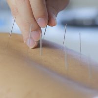 If you’re suffering from IBS, acupuncture as part of an integrative medicine approach, can help alleviate the pain.