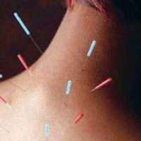 This study indicates that acupuncture improves disease activity, quality of...