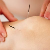 Not all pain needs to be treated with prescription medication. A recent advisory recommends opioid-free, non-addictive alternatives, like acupuncture, as the first step to relieve pain.