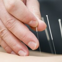 New FDA guidelines recommend doctors get information on acupuncture to help with pain management.